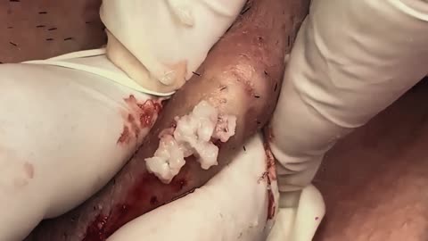 Black head removal in parlour #1