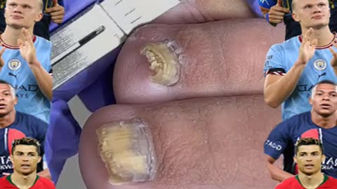 Cleaning is very needed! Home Service Pedicure Series #ingrowntoenail #toenails #pedicure (14)