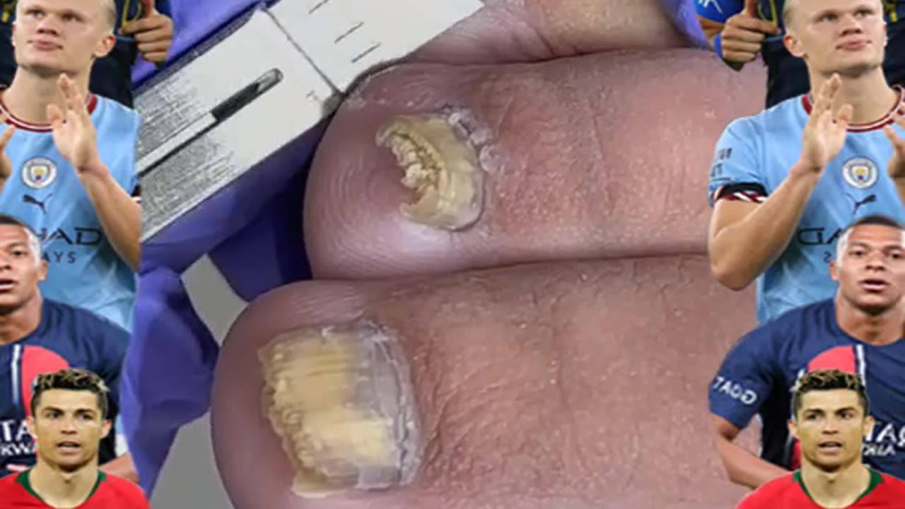 Cleaning is very needed! Home Service Pedicure Series #ingrowntoenail #toenails #pedicure (14)