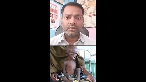 बच्चों के सूखा रोग का इलाज ।