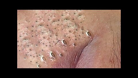 Blackheads Removal & Pimple Popper Extraction