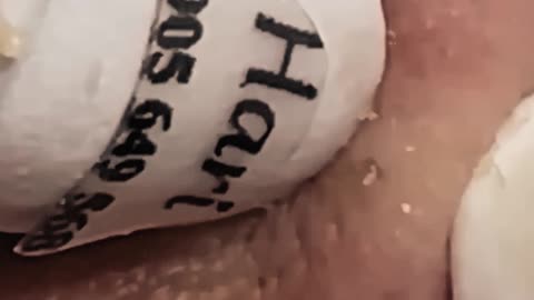 Blackheads Removal | Acne Treatment and Very Satisfying Satisfying Pimple pop (ASMR) #6 #blackheads