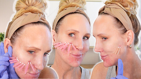 Lower & Mid Cheek Thread Lift - Acecosm.com code STACY10