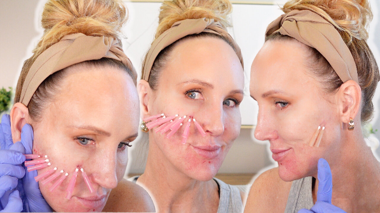 Lower & Mid Cheek Thread Lift - Acecosm.com code STACY10