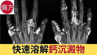 快速逆轉組織鈣化