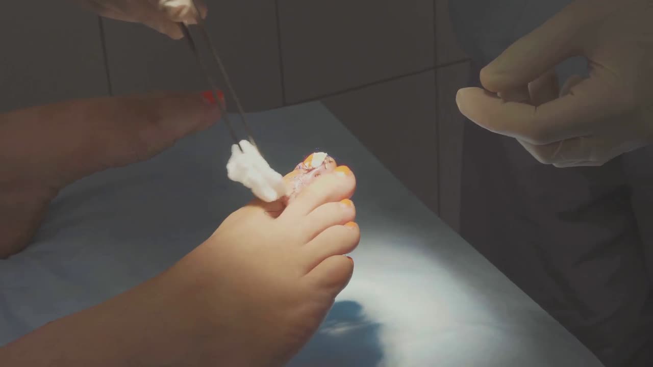 Say Goodbye to Ingrown Toenails: Easy Solutions!