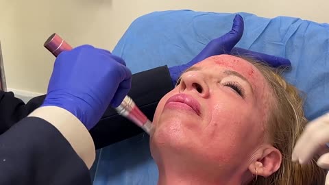 My Platelet-Rich Plasma (PRP) Treatment Journey: Boosting Skin Health