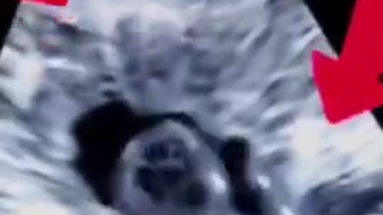 ultrasound of a baby struggling in agony against the forceps of an abortionist