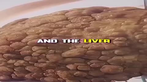Cancer Starts in the Gut