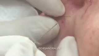 One lone lip blackhead Sorry it s slimpick in Sunday