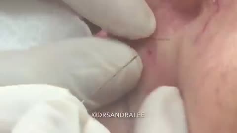 One lone lip blackhead Sorry it s slimpick in Sunday