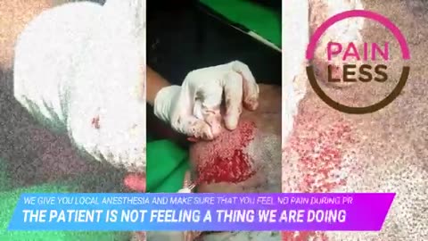 Hair Transplant in Navi Mumbai | Procedure, Cost & Real Results