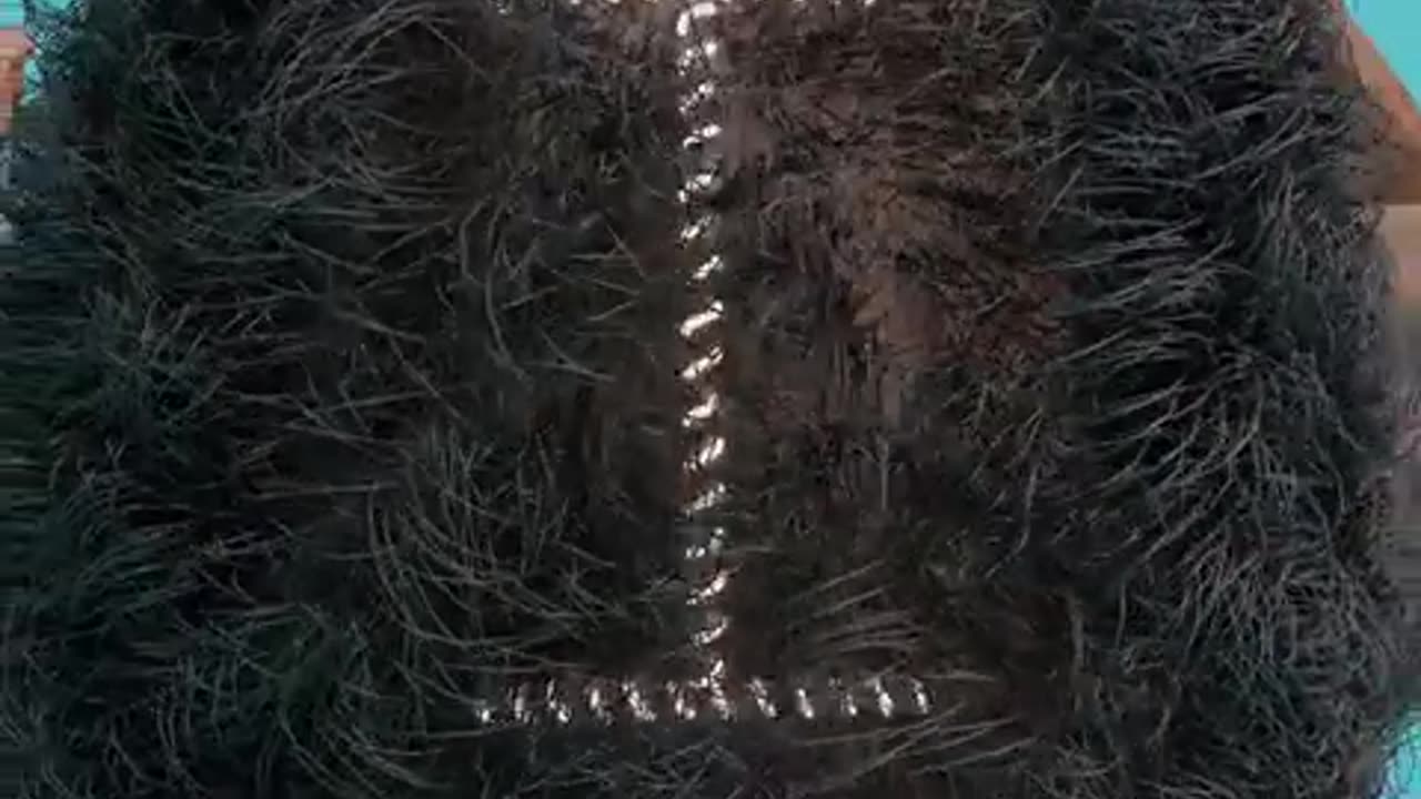 How Scalp Reduction Surgery Works