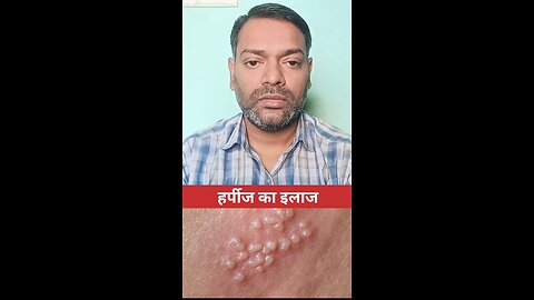 हर्पीज का इलाज ।