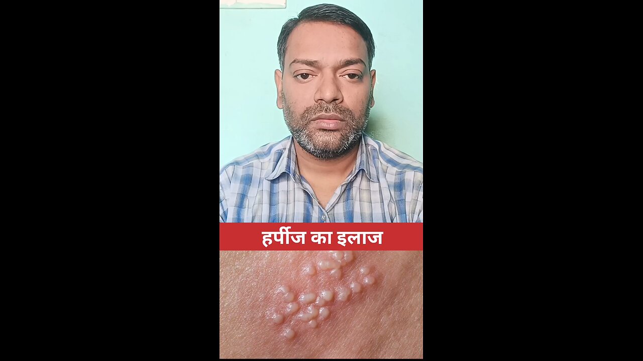 हर्पीज का इलाज ।