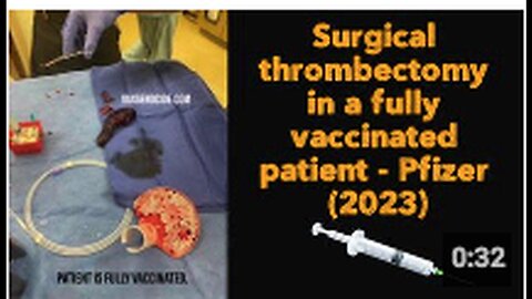 "2023 Pfizer Fully Vaccinated Patient Undergoes Surgical Thrombectomy"