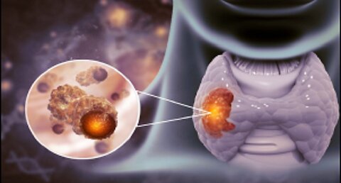 The Hidden Toxin Making Your Thyroid Tests "Normal"