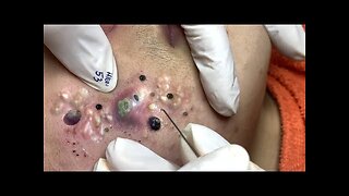 blackhead removal and Pimplepopper Spa relaxation #10116