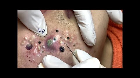blackhead removal and Pimplepopper Spa relaxation #10116