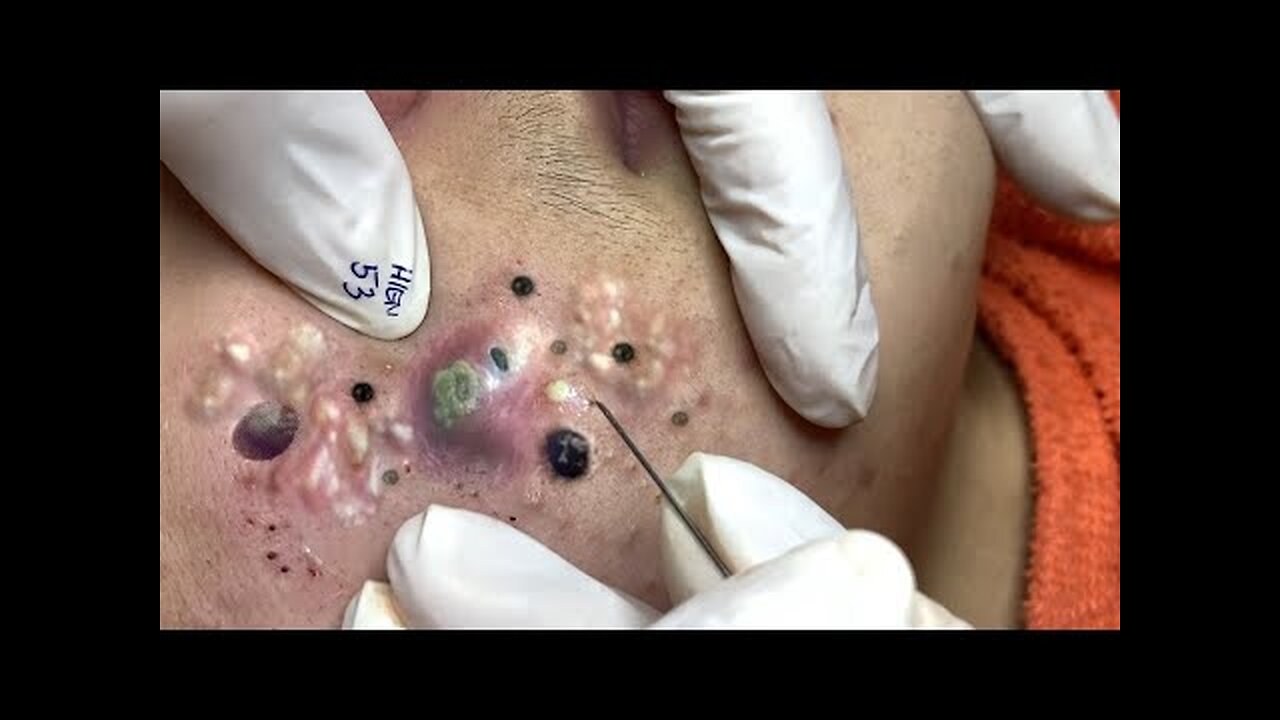 blackhead removal and Pimplepopper Spa relaxation #10116