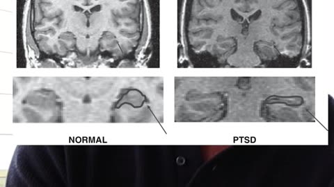 hippocampus looks like a squashed grape in PTSD