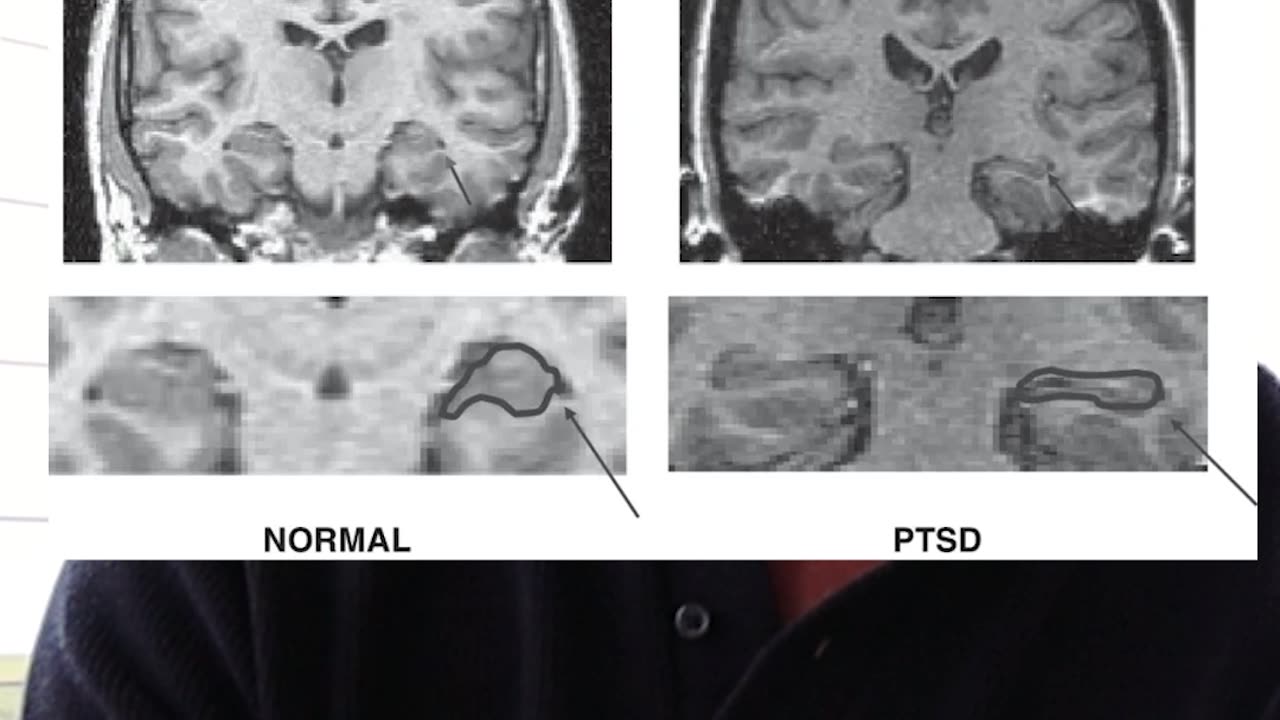 hippocampus looks like a squashed grape in PTSD