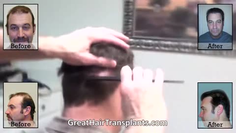 Great Hair Transplants: Dr. Brett Bolton’s Corrective Procedure