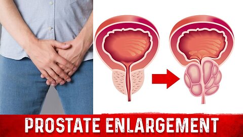 How To Shrink Enlarged Prostate Without Surgery