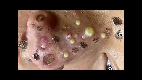 Blackheads Removal & Pimple Popper Cystic Acne Extraction #227