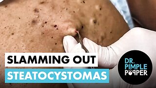 Slamming Out Steatocystomas