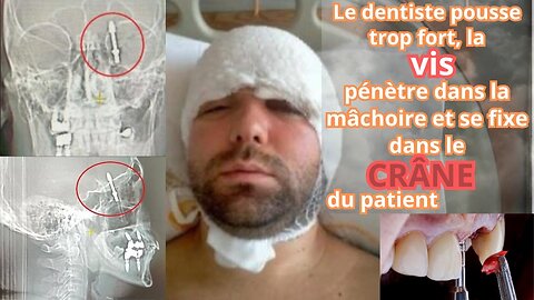 👨‍⚕️🛌 Le dentiste appuie trop fort, la vis perce la mâchoire et se fiche dans le crâne du patient.