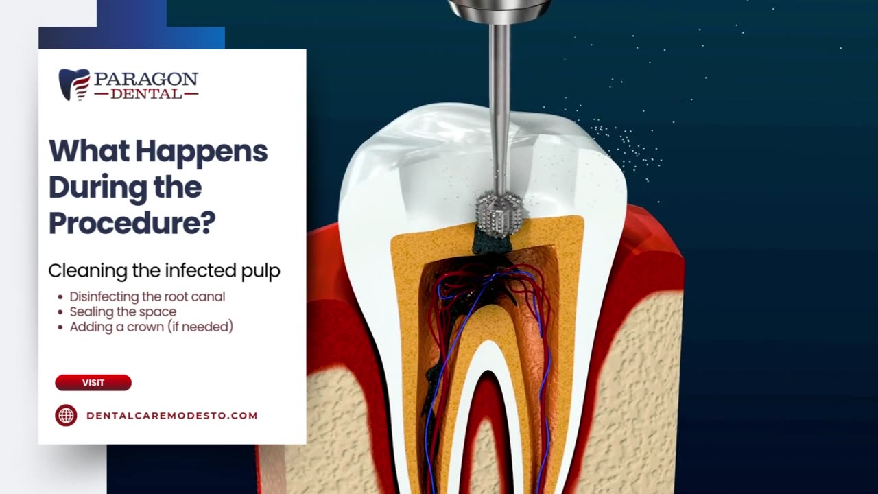 Root Canal Therapy for Teenagers