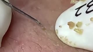 Relaxing Big Cystic Acne Blackheads Extraction