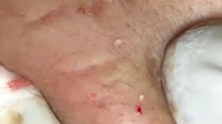 Blackheads Removal & Pimple Popper Cystic Acne Extraction #227