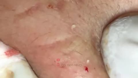 Blackheads Removal & Pimple Popper Cystic Acne Extraction #227