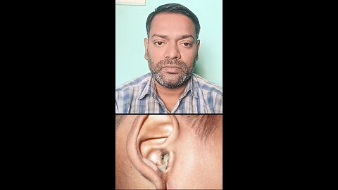 कान के बहने का इलाज ।