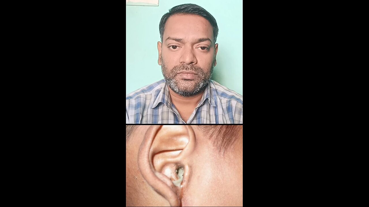 कान के बहने का इलाज ।