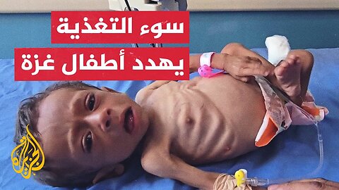 أوضاع صعبة تواجه أطفال غزة في مستشفى الرنتيسي جراء التجويع