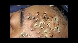 Blackheads Removal & Pimple Popper Cystic Acne Extraction 6