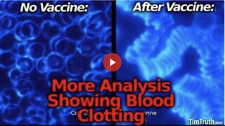 More Vaccine Bloodwork: Blood Cells Reportedly Clotting After Vaccine