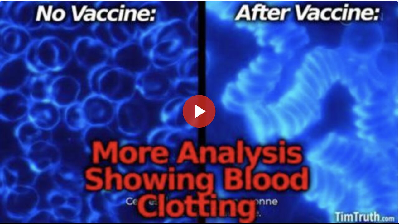 More Vaccine Bloodwork: Blood Cells Reportedly Clotting After Vaccine