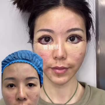Asian women are opting for beauty treatments for wider eyes