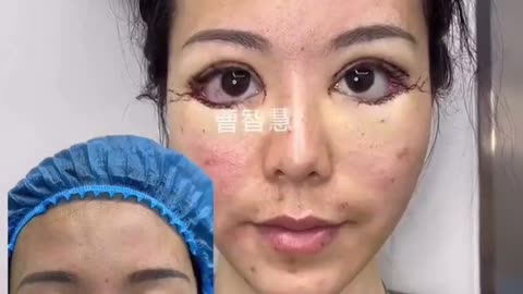 Asian women are opting for beauty treatments for wider eyes