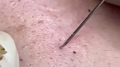 Blackhead Removal ASMR - Doctor Pimple Popper Inspired