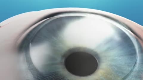 LASIK Eye Surgery 3D Animation
