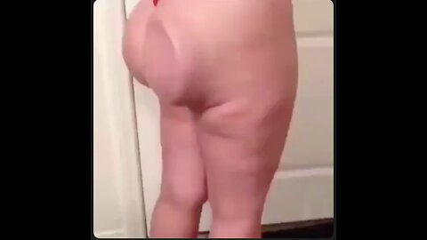 Butt implant issues...looks like a half assed job to me. She paid money for this