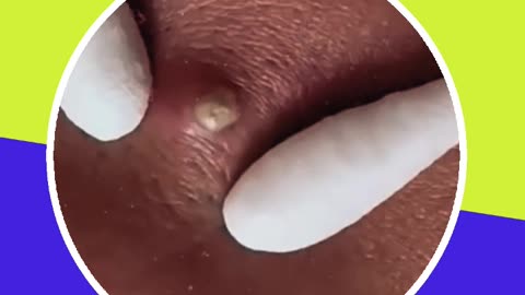 Pimple removal satisfying video (ASMR) #17 #shorts
