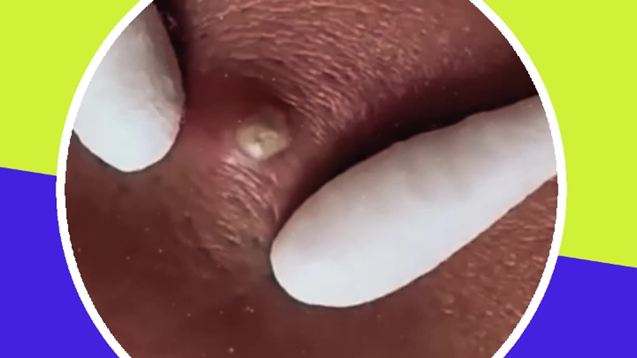 Pimple removal satisfying video (ASMR) #17 #shorts