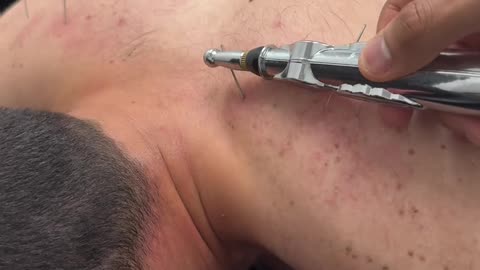Akupunktur therapy