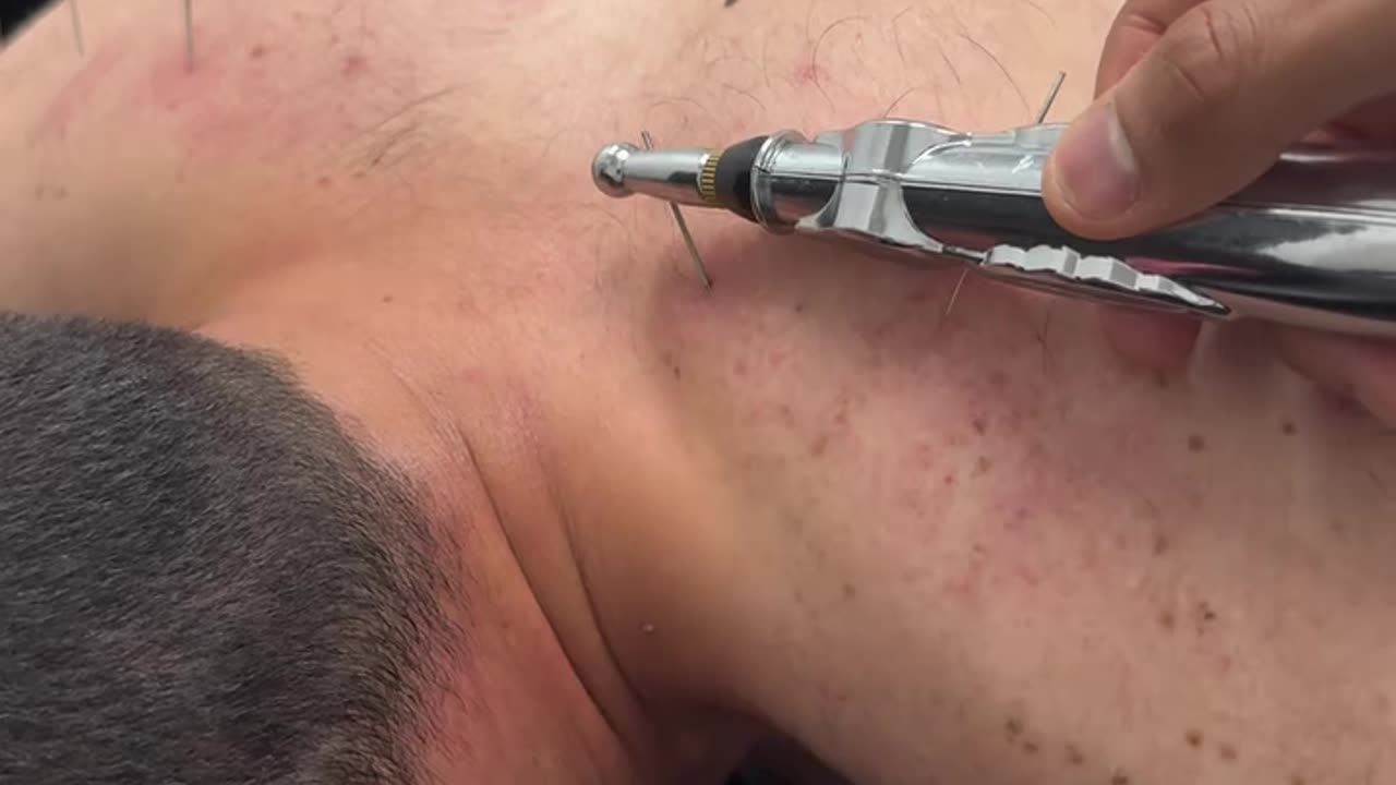 Akupunktur therapy